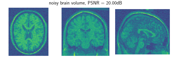 noisy brain volume, PSNR = 20.00dB