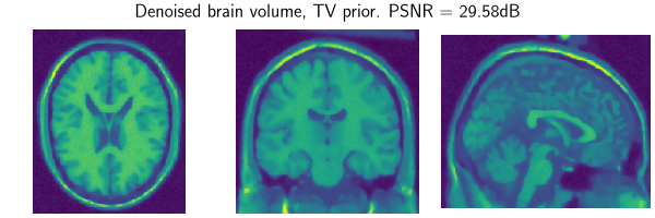 Denoised brain volume, TV prior. PSNR = 29.58dB